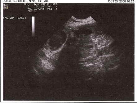Ultrasound
